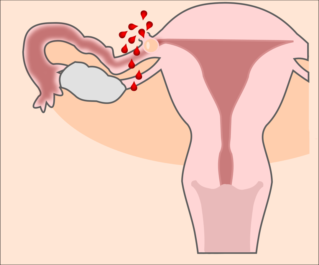 الحمل خارج الرحم